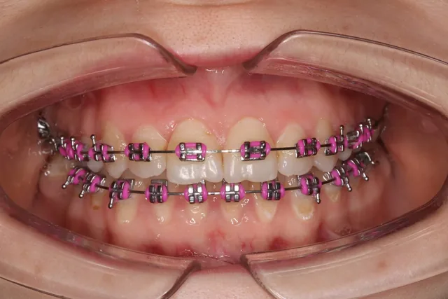 Aparat dentar fix cu bracket-uri metalice și elastice roz, montat pe arcada superioară și inferioară