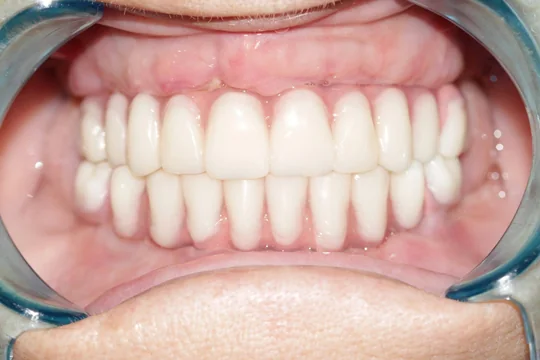 Arcade dentare complet reabilitate cu lucrări ceramice albe, fotografiate cu depărtător